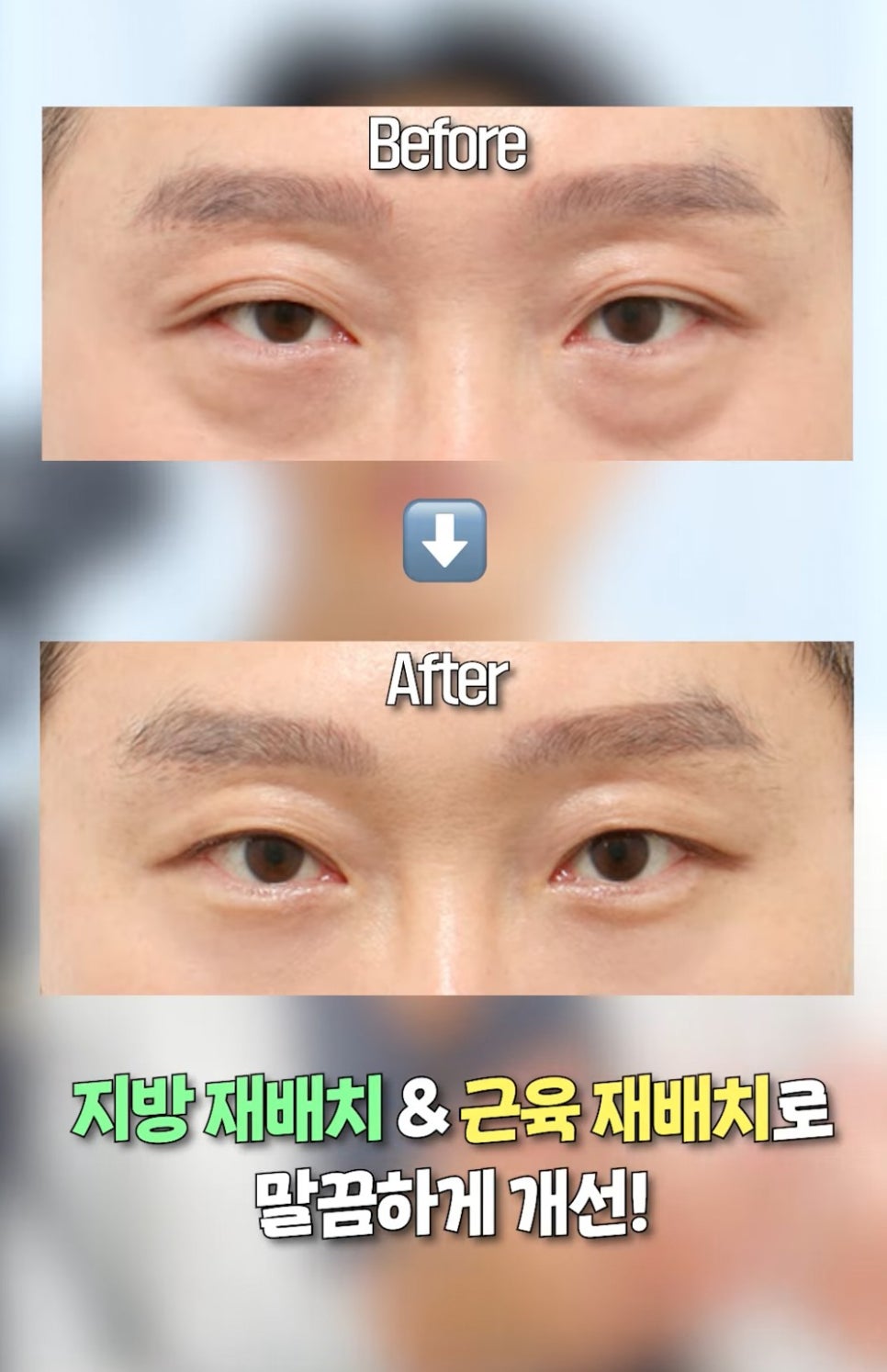 [에톤TV] 눈밑지방재배치, 역대급 가성비 수술인 이유 관련 이미지 2