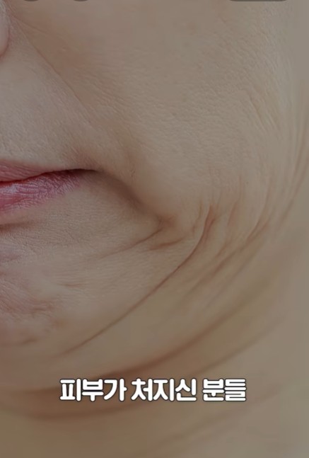 [에톤TV] 울쎄라, 누구에게 독이 되고 약이 될까? 시술 전 꼭 확인하세요! 관련 이미지 2