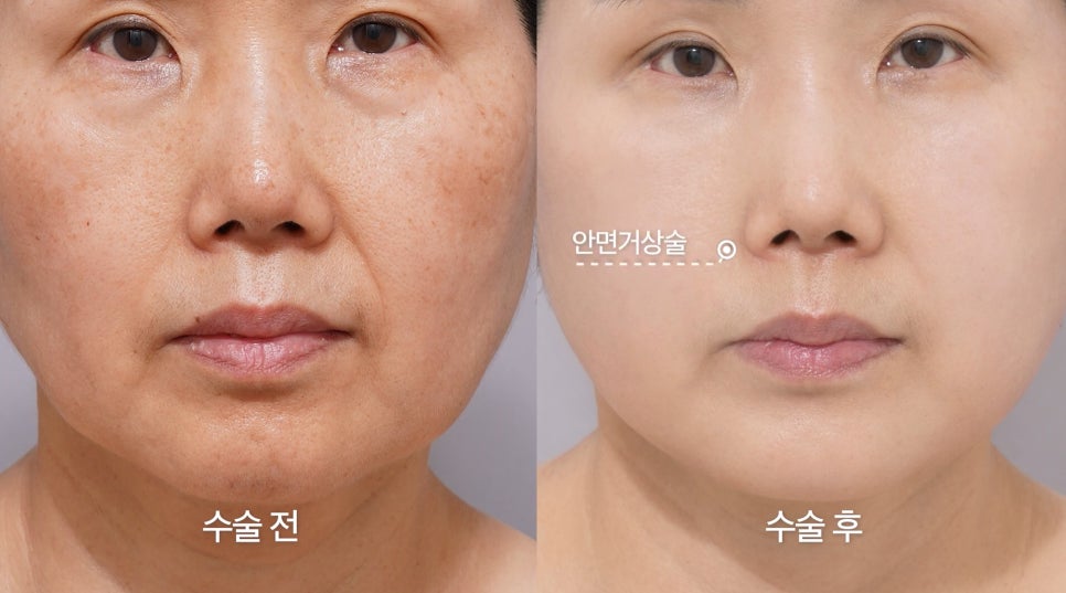 [Eton TV] A Housewife in Her 60s Shares Her Anti-Aging Surgery Review After Looking 10 Years Younger image 6