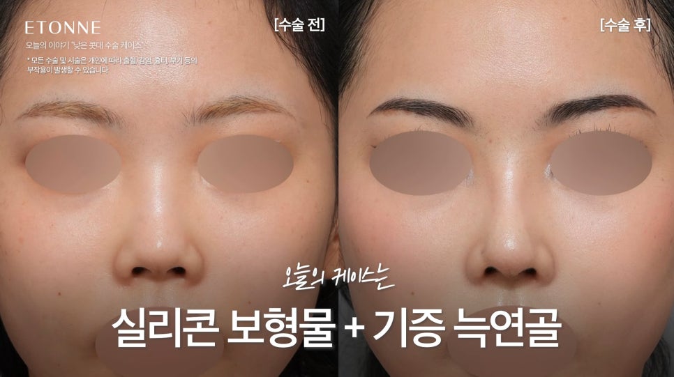 [에톤TV] 작은 코, 낮은 코, 낮은 콧대에 입체감을 주는 코 성형 리뷰 관련 이미지 3