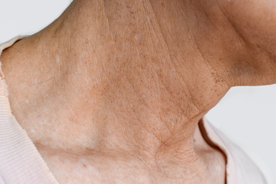 If You Want to Get Rid of Sagging Double Chin Skin and Neck Wrinkles image 1