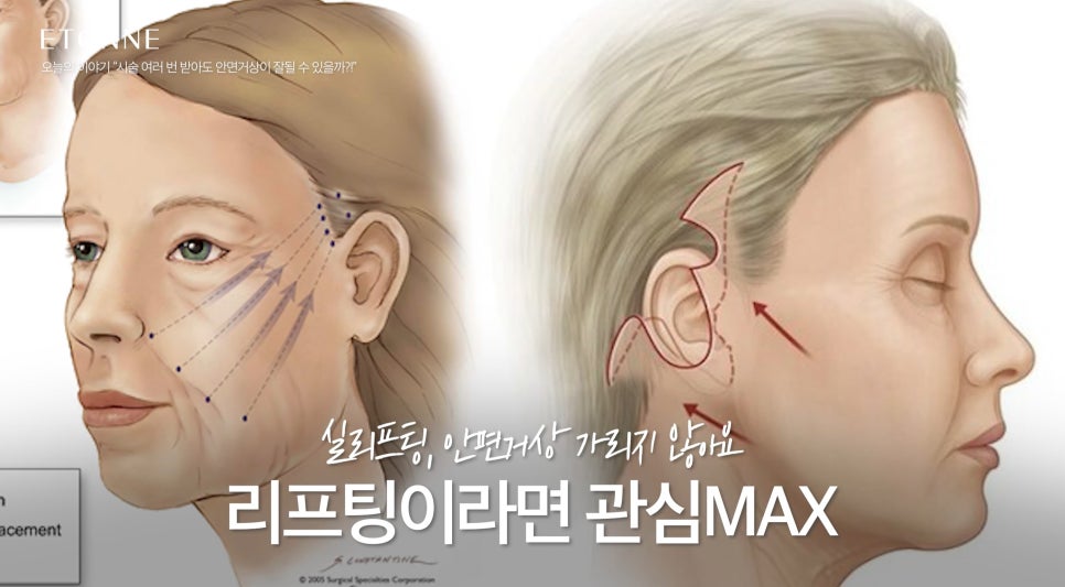 [Eton TV] Even After Multiple Thread-Lifting Procedures image 4