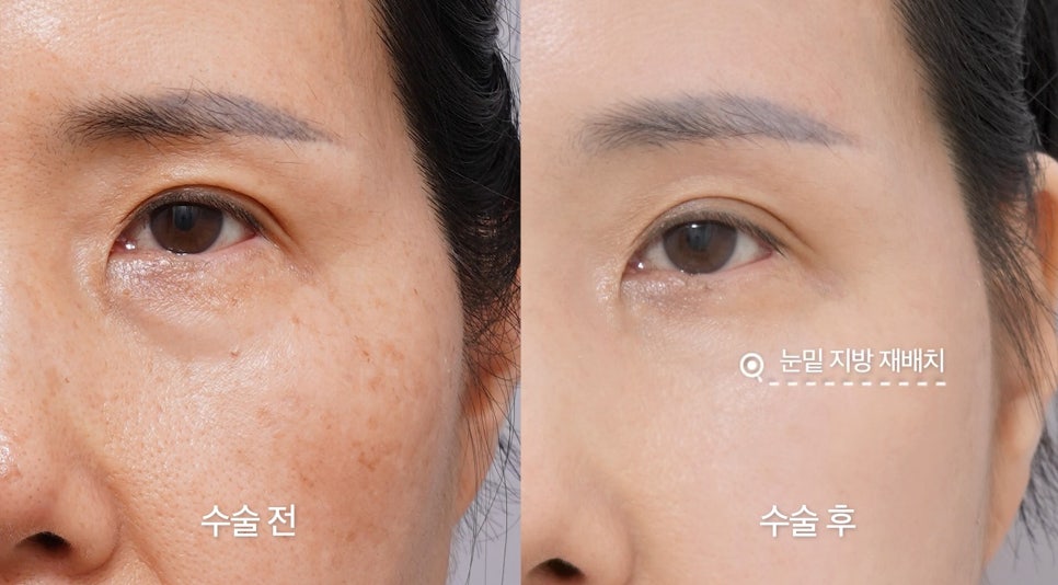 [Eton TV] A Housewife in Her 60s Shares Her Anti-Aging Surgery Review After Looking 10 Years Younger image 8