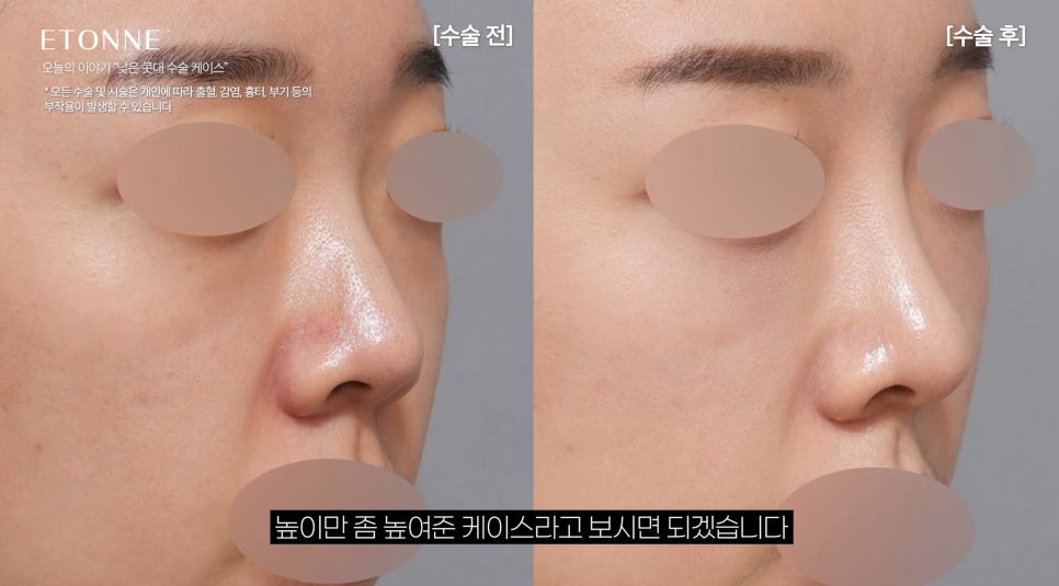 [에톤TV] 코 성형에서 콧대가 중요한 이유 (낮은 콧대 수술 케이스) 관련 이미지 2