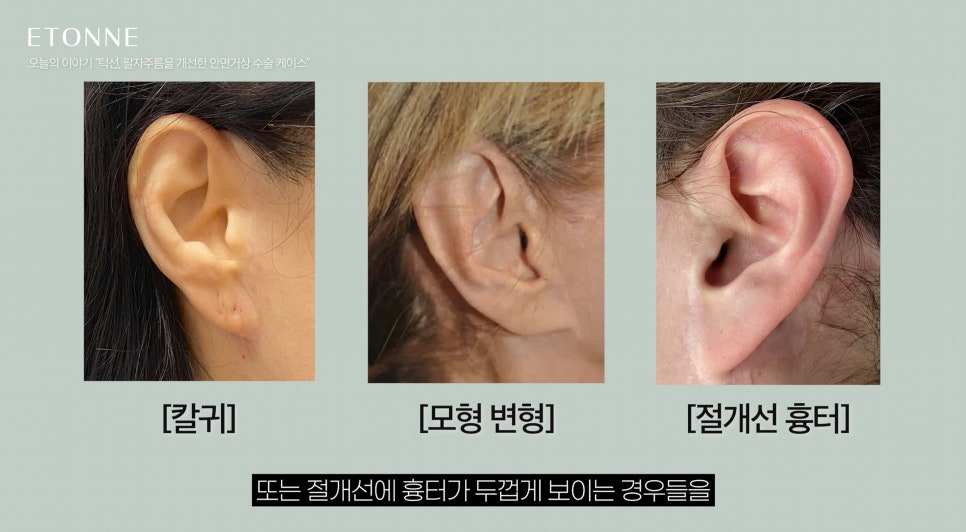 [에톤TV] 10년 젊어지는 기적, 안면거상술로 되찾는 청춘 (턱선, 팔자주름을 개선한 60대 여성 케이스) 관련 이미지 5