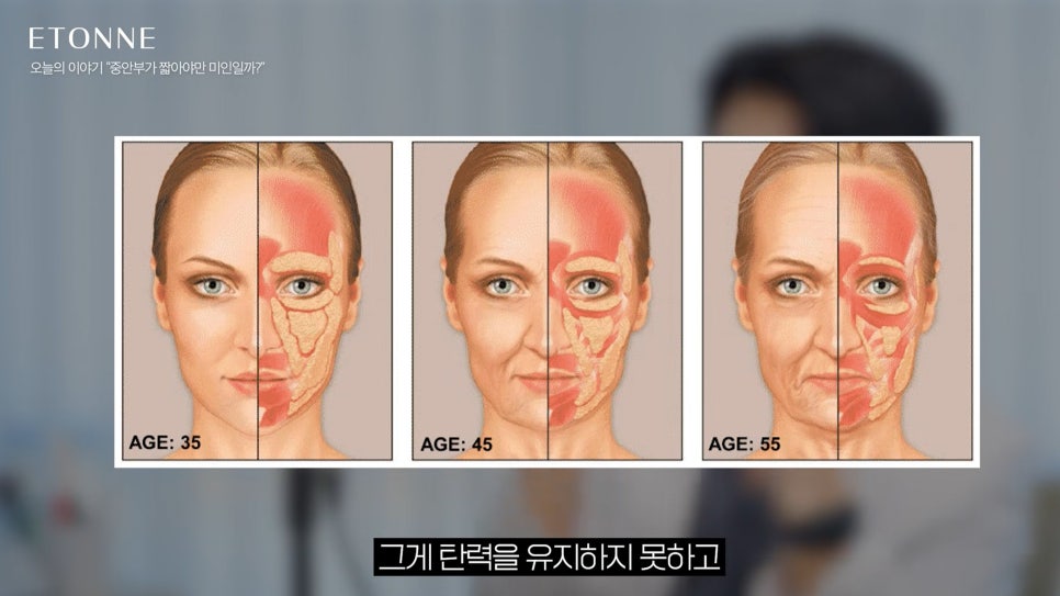 [Etone TV] The reasons behind the obsession with the “midface” and its real effects, as explained by a plastic surgeon image 6