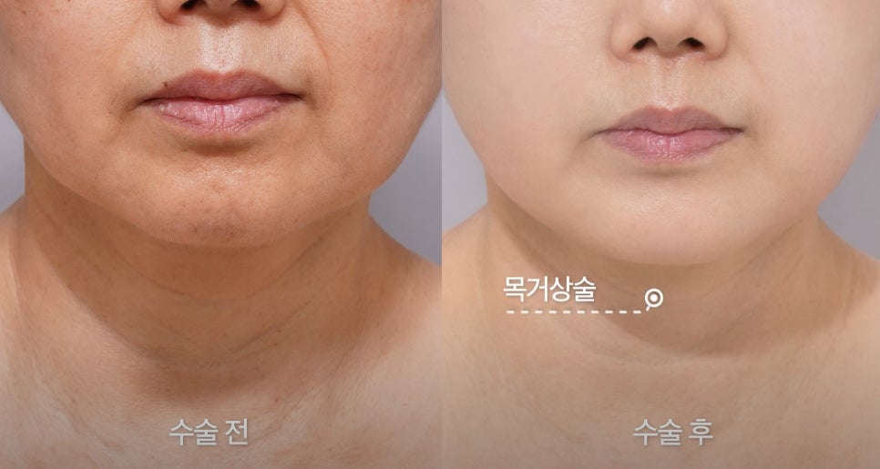 [Eton TV] A Housewife in Her 60s Shares Her Anti-Aging Surgery Review After Looking 10 Years Younger image 9