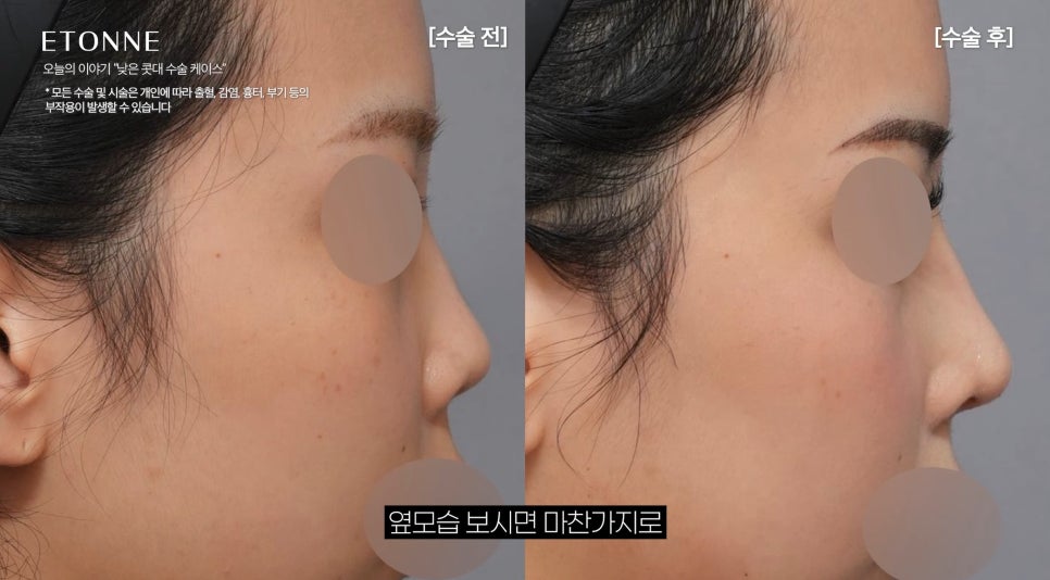 [에톤TV] 작은 코, 낮은 코, 낮은 콧대에 입체감을 주는 코 성형 리뷰 관련 이미지 2