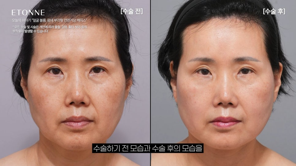 [에톤TV] 얼굴 볼륨, 광대 부각의 경우는 &lsquo;안면거상&rsquo;을 추천합니다 (50대 여성 팔자주름, 마리오네트 라인, 턱라인) 관련 이미지 2