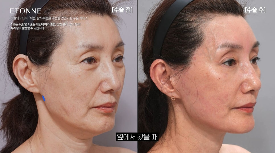 [에톤TV] 10년 젊어지는 기적, 안면거상술로 되찾는 청춘 (턱선, 팔자주름을 개선한 60대 여성 케이스) 관련 이미지 3