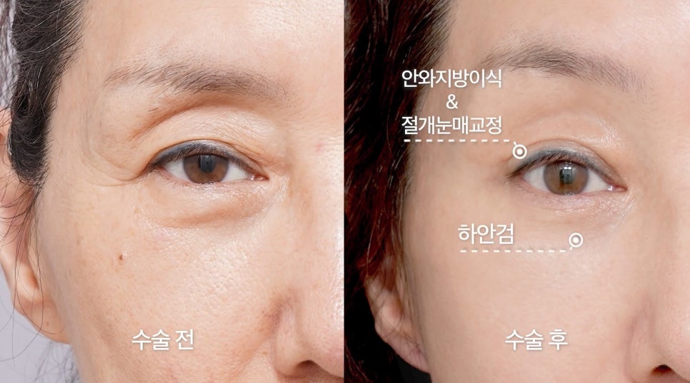 [Aeton TV] Regaining a Mother’s Confidence Through a Facelift: Anti-Aging Surgery Review image 7