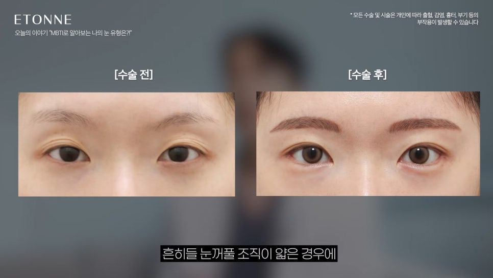 [에톤TV] What Is My Eye Type According to Eye MBTI? image 8