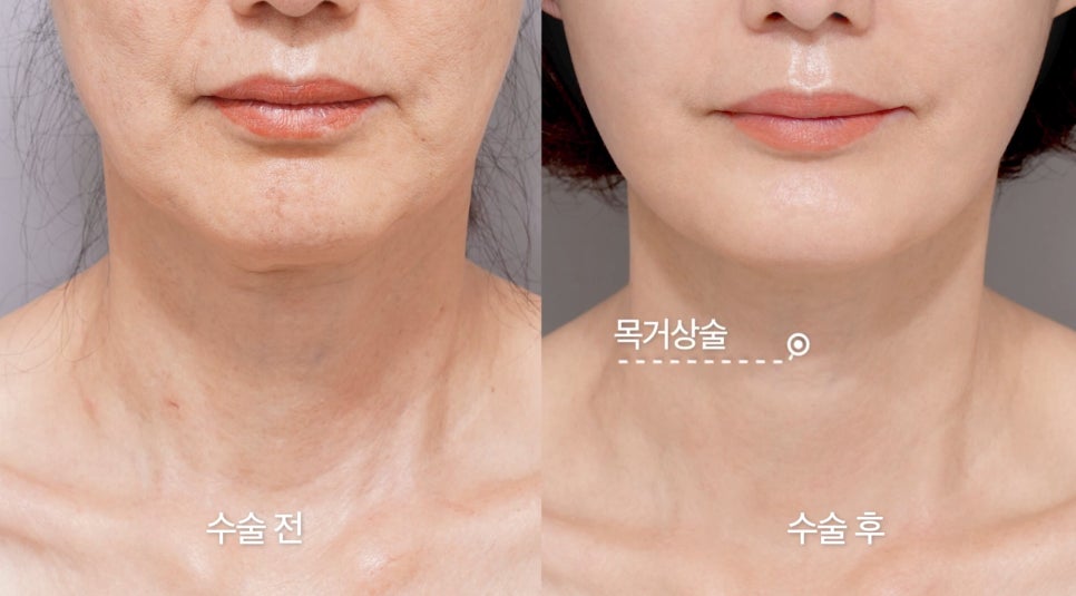 [Aeton TV] Regaining a Mother’s Confidence Through a Facelift: Anti-Aging Surgery Review image 8