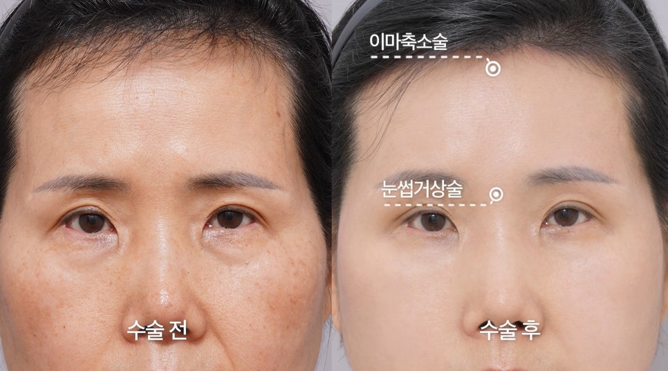[Eton TV] A Housewife in Her 60s Shares Her Anti-Aging Surgery Review After Looking 10 Years Younger image 7