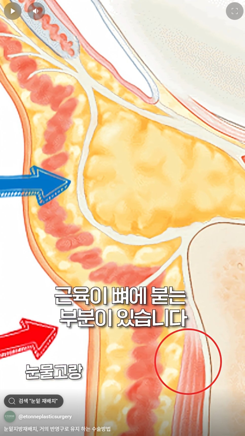 [EtonTV] Under-Eye Fat Repositioning: A Surgical Method That Lasts Almost Permanently image 3