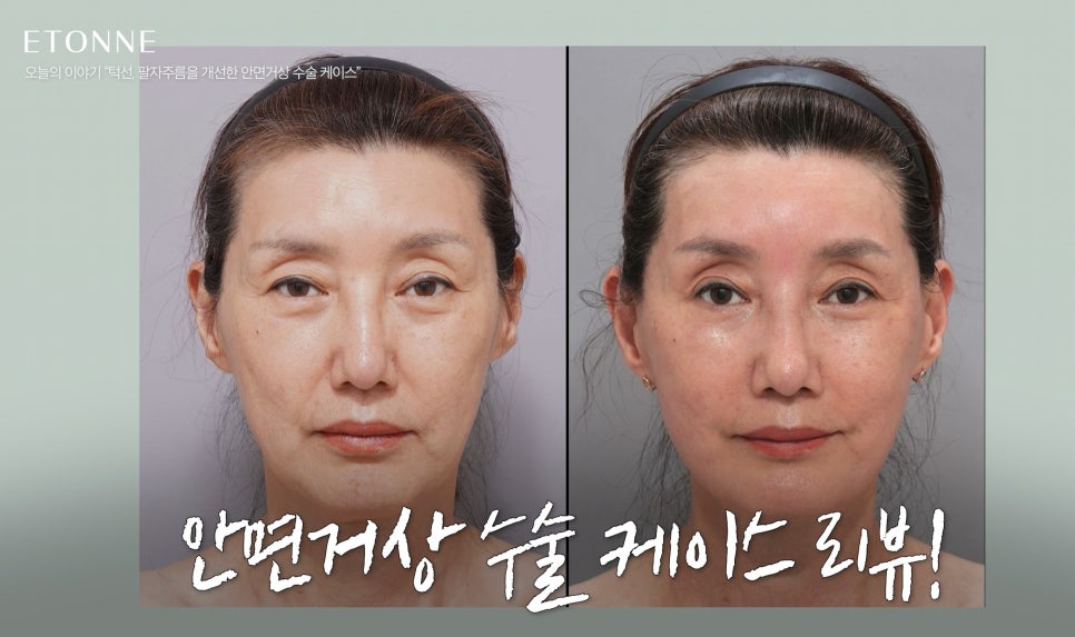 [에톤TV] 10년 젊어지는 기적, 안면거상술로 되찾는 청춘 (턱선, 팔자주름을 개선한 60대 여성 케이스) 관련 이미지 2