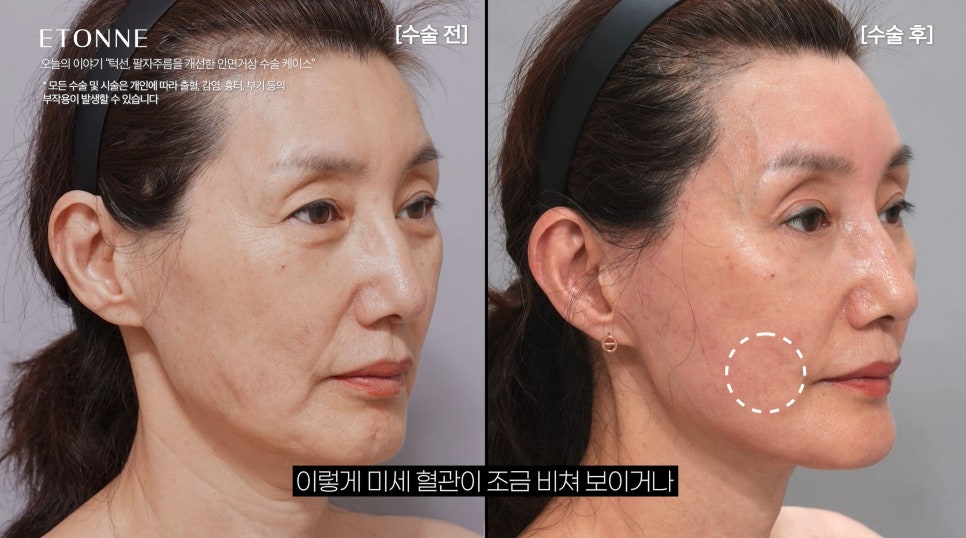 [에톤TV] 10년 젊어지는 기적, 안면거상술로 되찾는 청춘 (턱선, 팔자주름을 개선한 60대 여성 케이스) 관련 이미지 7