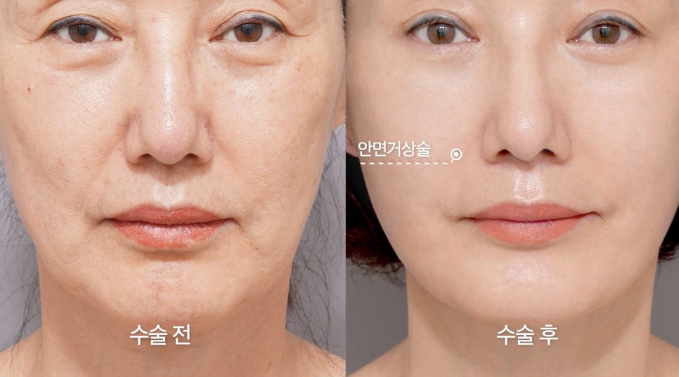 [Aeton TV] Regaining a Mother’s Confidence Through a Facelift: Anti-Aging Surgery Review image 5