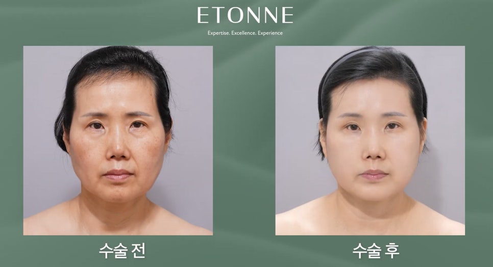 [Eton TV] A Housewife in Her 60s Shares Her Anti-Aging Surgery Review After Looking 10 Years Younger image 5
