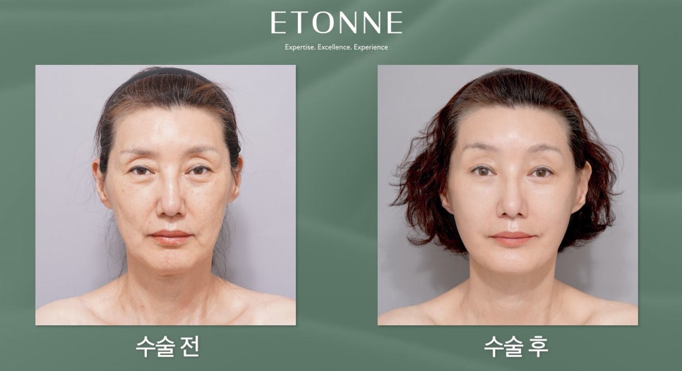 [Aeton TV] Regaining a Mother’s Confidence Through a Facelift: Anti-Aging Surgery Review image 4