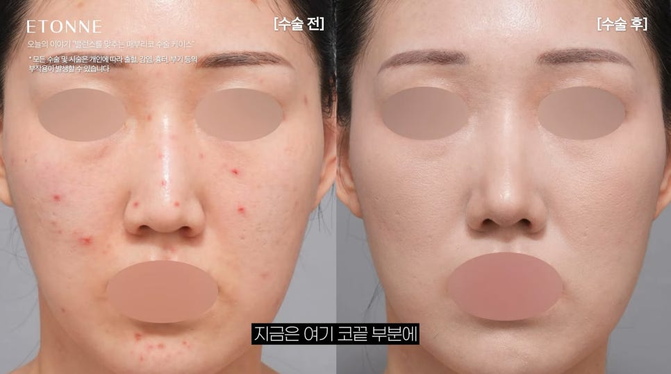 [에톤TV] 매부리코 성형 전후, 밸런스를 맞춰 드립니다 관련 이미지 3