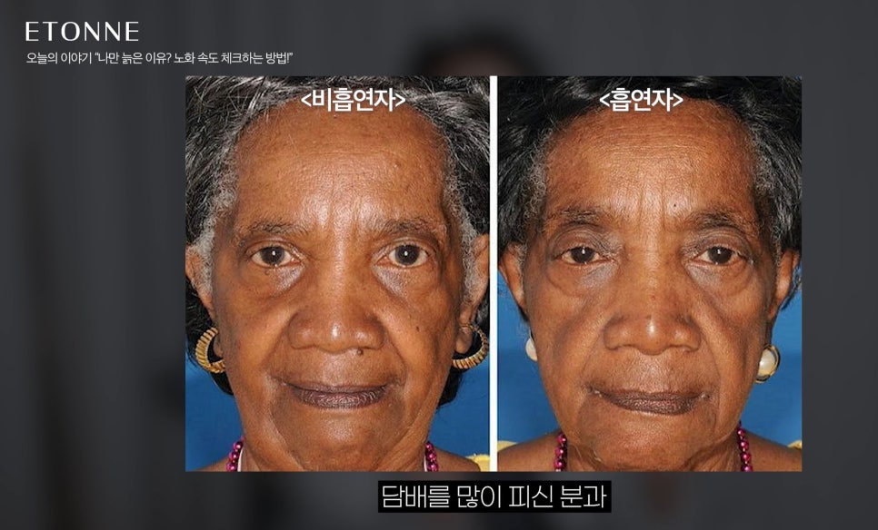 [에톤TV] 노안과 동안은 유전자일까? 관리의 결과일까? 관련 이미지 3