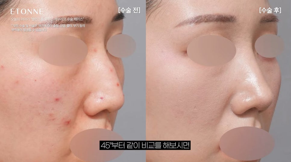 [에톤TV] 매부리코 성형 전후, 밸런스를 맞춰 드립니다 관련 이미지 2