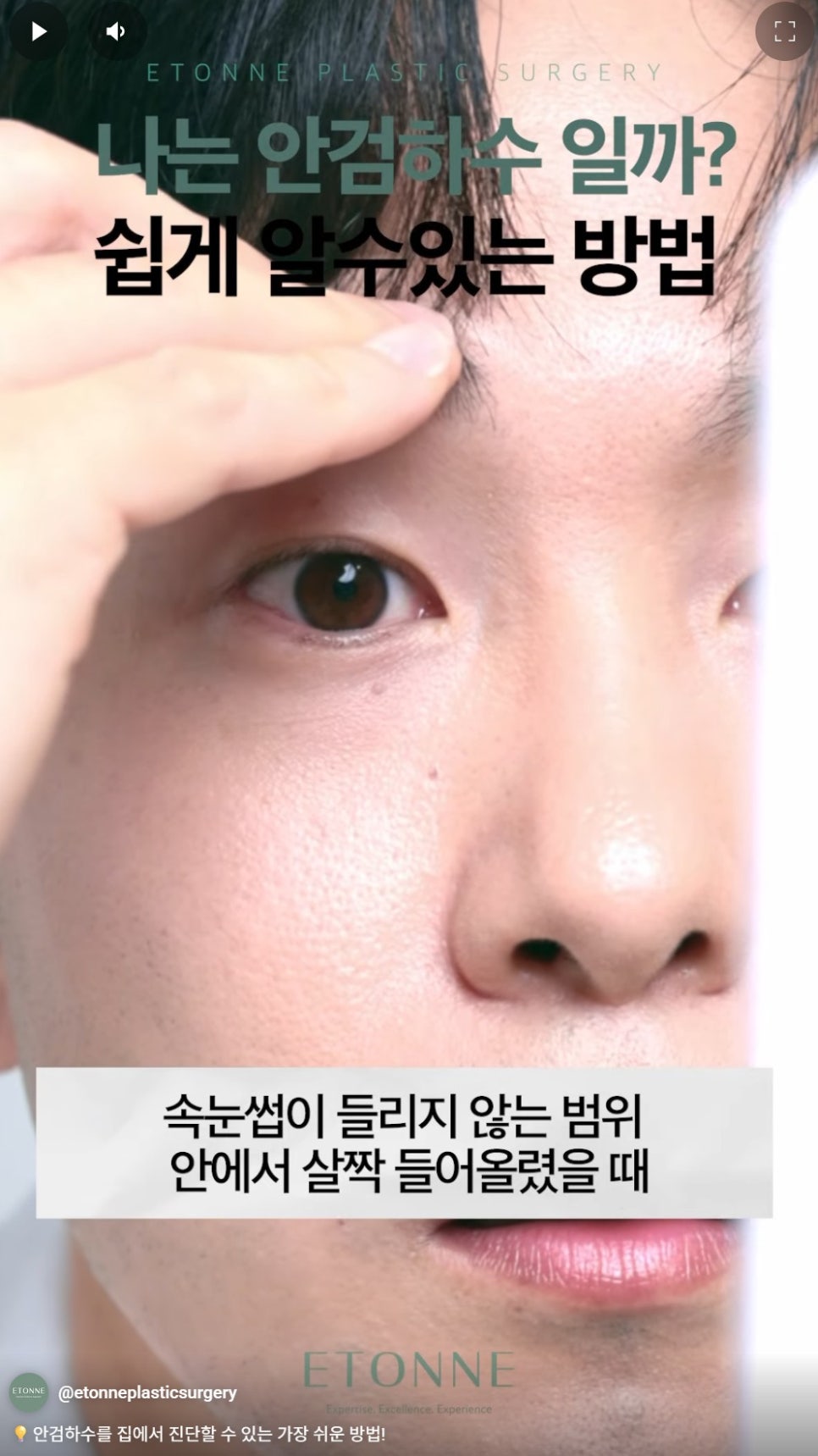 [에톤TV] 안검하수를 진단하는 가장 쉬운 방법 관련 이미지 3