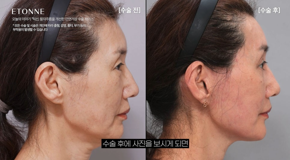 [에톤TV] 10년 젊어지는 기적, 안면거상술로 되찾는 청춘 (턱선, 팔자주름을 개선한 60대 여성 케이스) 관련 이미지 4