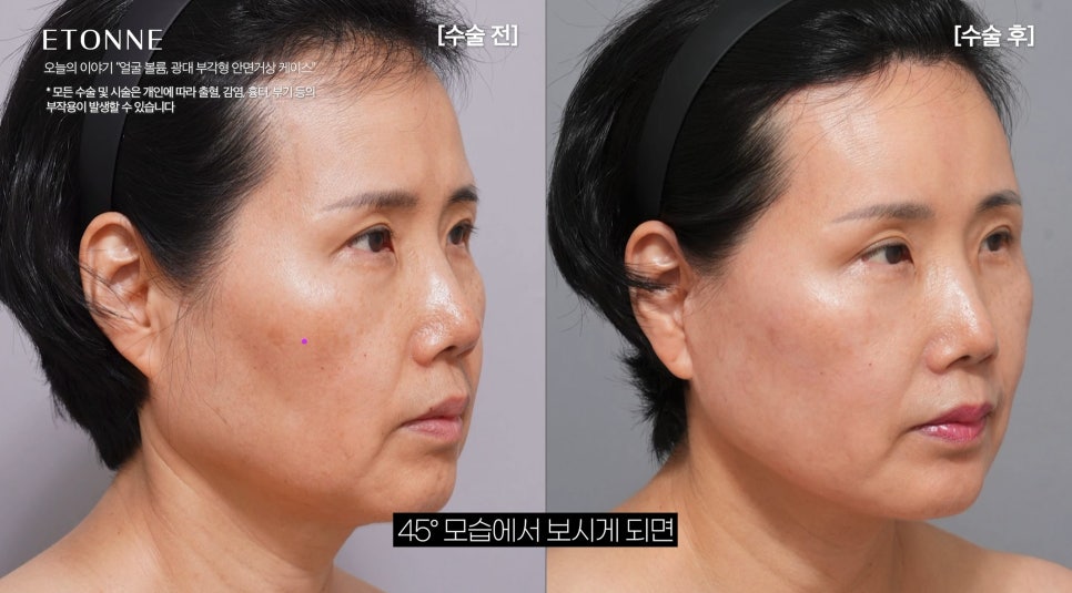 [에톤TV] 얼굴 볼륨, 광대 부각의 경우는 &lsquo;안면거상&rsquo;을 추천합니다 (50대 여성 팔자주름, 마리오네트 라인, 턱라인) 관련 이미지 4