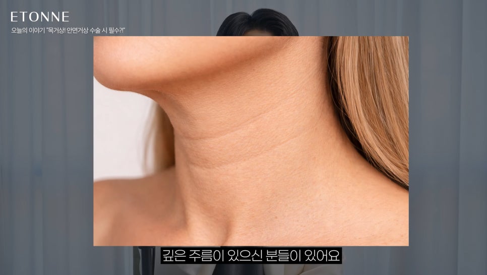 [에톤TV] 안면거상 수술 시, 목거상은 필수일까요?! 관련 이미지 3