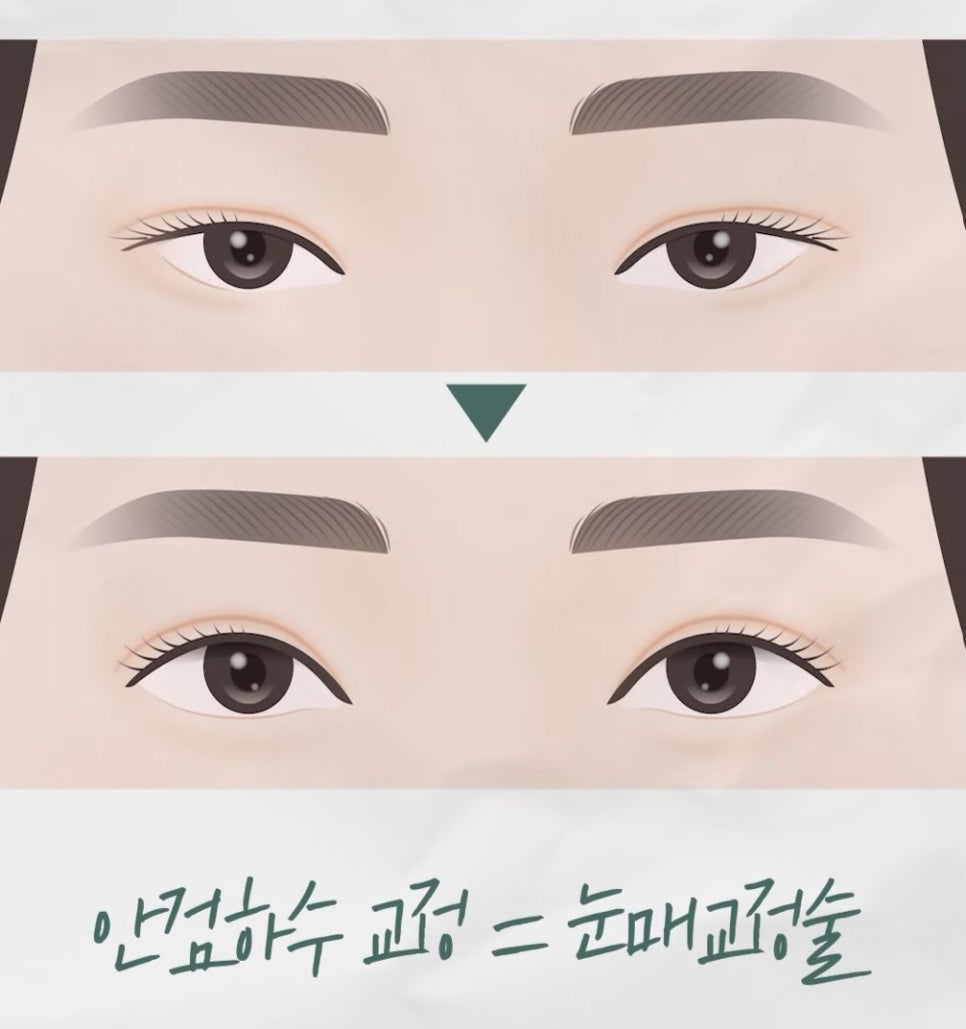 [Eton TV] What a Plastic Surgery Specialist Says Determines the Sparkle in the Eyes image 4