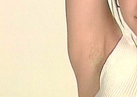 영등포 제모 겨드랑이 레이저제모 관련 이미지 1