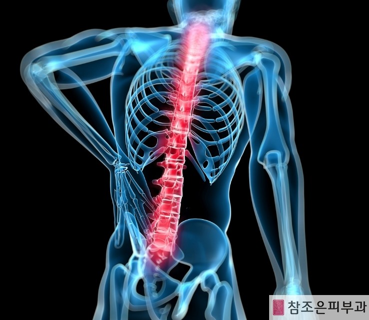 신경통이나 다른 후유증에 고생하는 대상포진 제때 치료받아야... 영등포 당산역 참조은피부과 관련 이미지 4