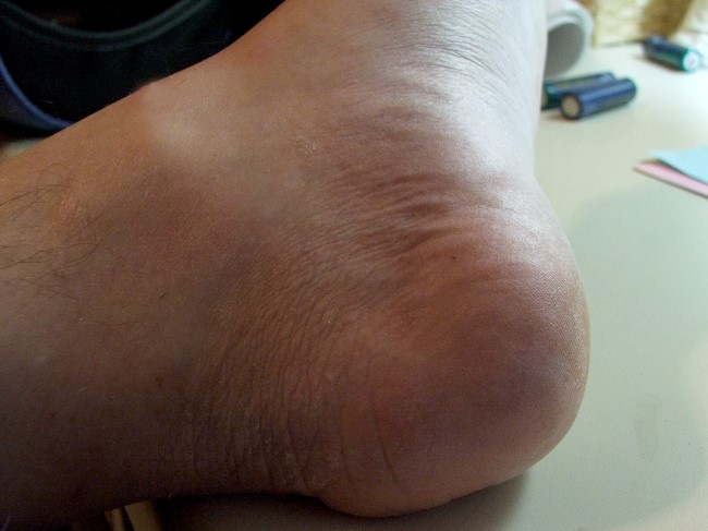 당산역 무좀치료, 무좀은 어떻게 치료해야할까요? 관련 이미지 2