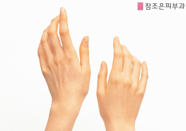 건선의 동반성질환 건선성 관절염 알고 계신가요? - 영등포 참조은피부과 관련 이미지 3
