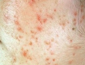 여드름 없애기 여드름 흉터치료를 알아봅시다. 관련 이미지 4