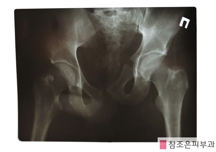 건선의 동반성질환 건선성 관절염 알고 계신가요? - 영등포 참조은피부과 관련 이미지 6
