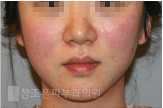 당산역아토피치료/ 아토피에 대해서 알아보자!! 관련 이미지 5