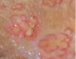 당산역 발습진 치료 소개드립니다. 관련 이미지 3