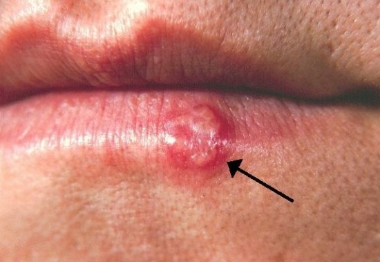 당산역피부과  헤르페스바이러스감염증은 무엇일까요? 관련 이미지 2