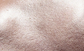 참조은피부과 크라이오셀을 소개드립니다. 관련 이미지 5