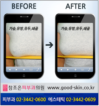 [양평동반영구클리닉] 유두의크기가 달라서 고민이라면?? 관련 이미지 4