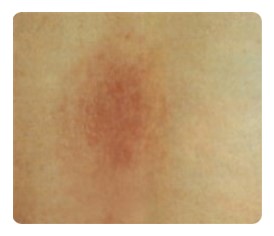 [당산동피부과]접촉성 피부염(contact dermatitis) 제대로 알고 치료하자!! 관련 이미지 1