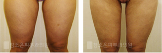 [당산동비만클리닉] 지방분해주사효과!! 관련 이미지 4