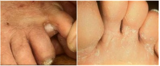 당산역 무좀치료, 무좀은 어떻게 치료해야할까요? 관련 이미지 1