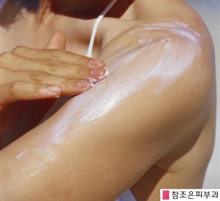 [공유] 휴가뒤 후유증 일광화상, 일사병 땀띠 치료- 당산역 참조은피부과 관련 이미지 3