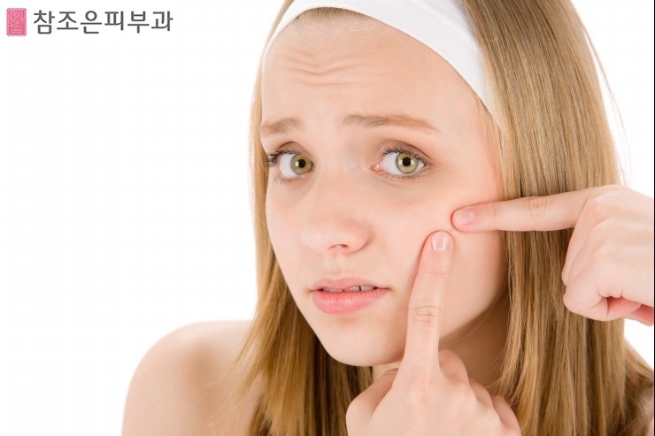 양평동피부과 - 참조은피부과에서 알아보는 여드름의 증상과 예방법 관련 이미지 2