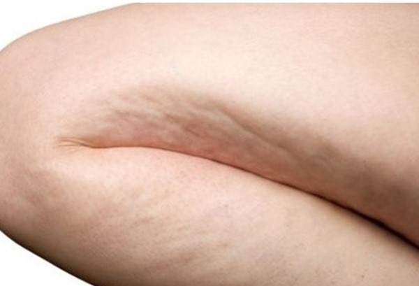 튼살의 원인과 튼살의 치료를 설명드리겠습니다. 관련 이미지 1