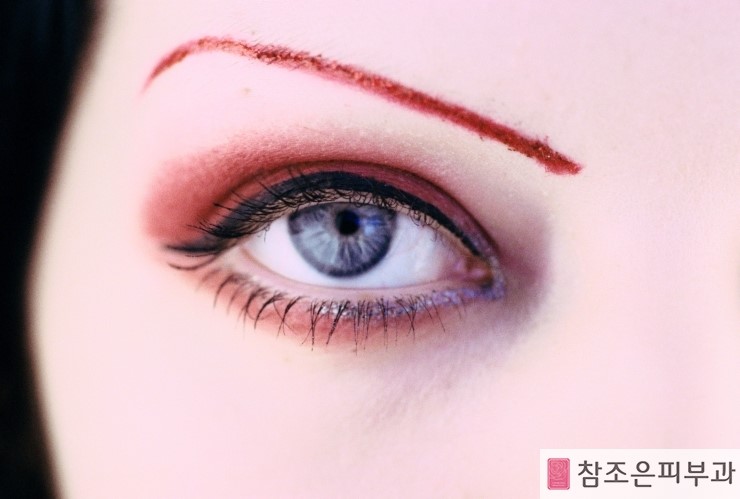 탈모,백반증도 반영구화장으로 개선할수 있다 - 당산역 참조은피부과 관련 이미지 7